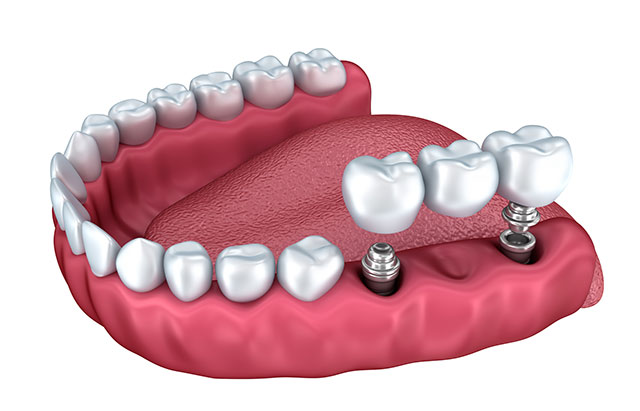 Prosthetic implants